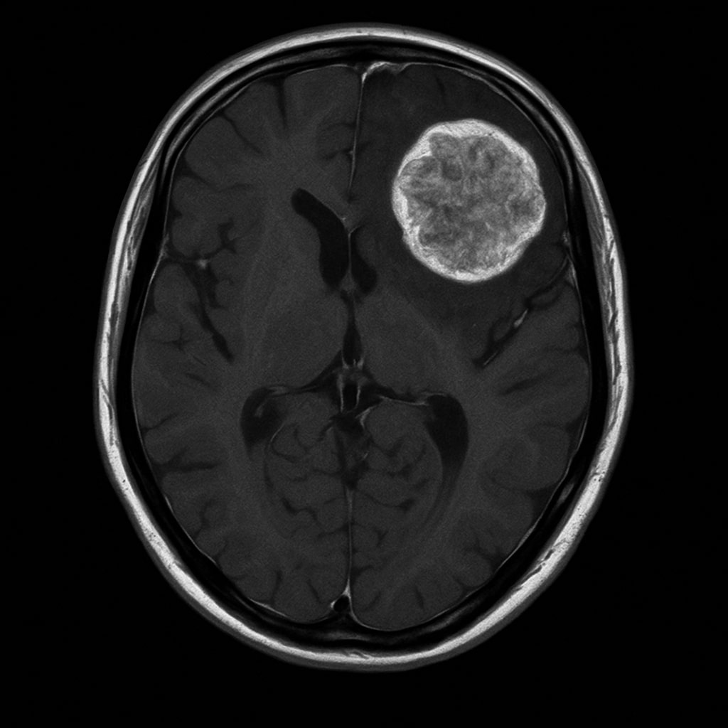 Brain surgery in Germany
